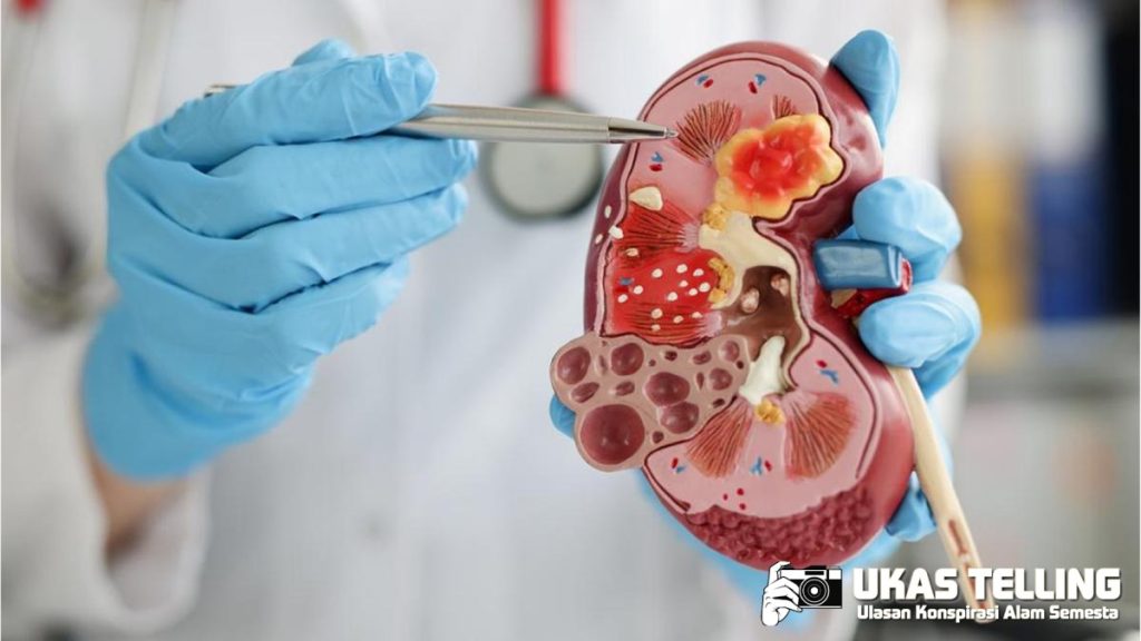 Perut dan Dada Terasa Sakit? Waspadai Gejala Ginjal Bermasalah!