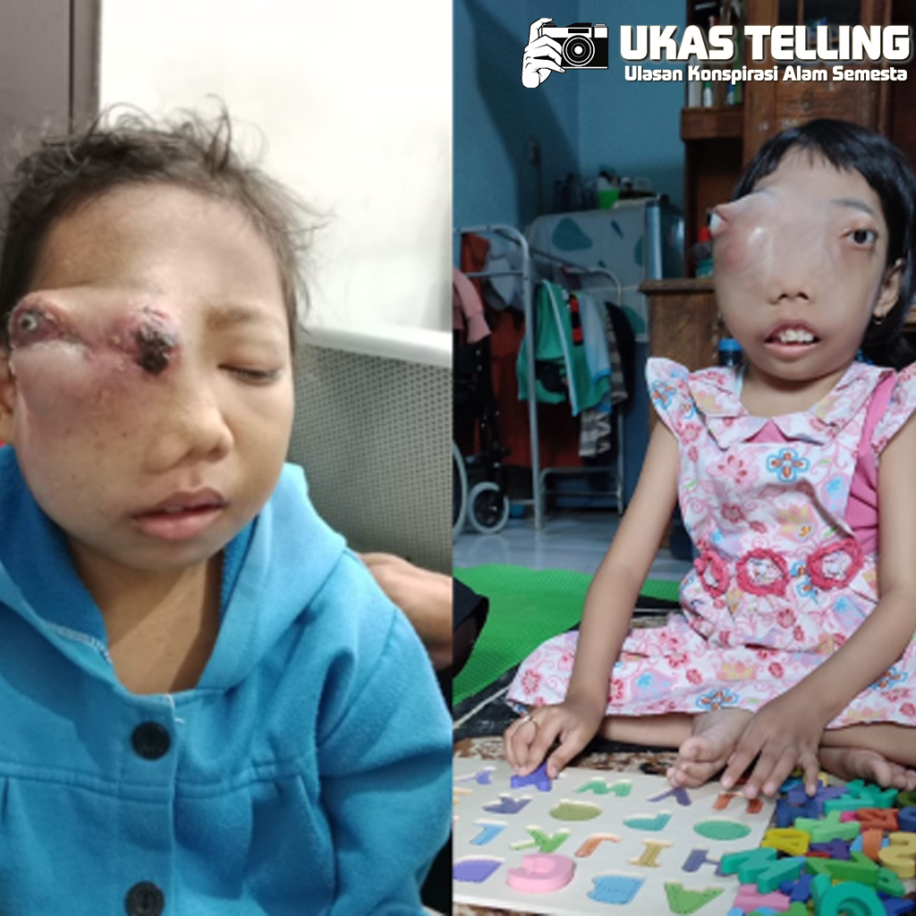 Langkah Kecilmu, Doa Besar untuk Pejuang Kanker Cilik!